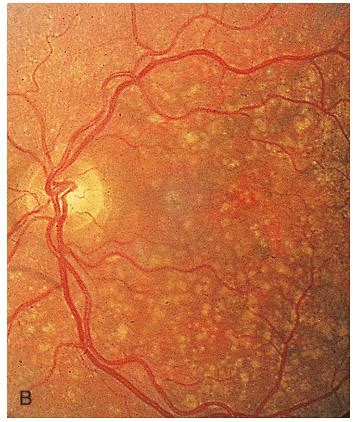 drusen bodies   retina  scientific diagram