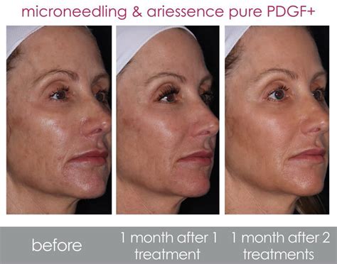 discover       ariessence pure pdgf renu med