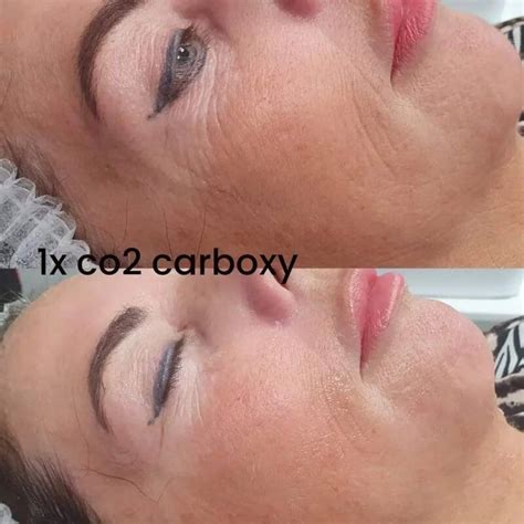 Carboxy CO2 Lift Masker bij Beauty Within Purmerend Centrum