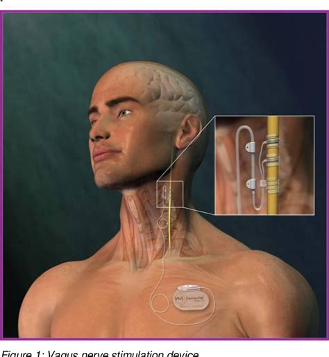 Figure 1 from Vagus Nerve Stimulation | Semantic Scholar