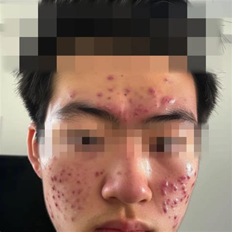 Effective Cystic Acne Treatment in Singapore by Doctor (2025)