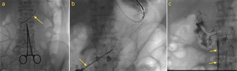 gastrostomy tube insertion rig radiology  st vincents