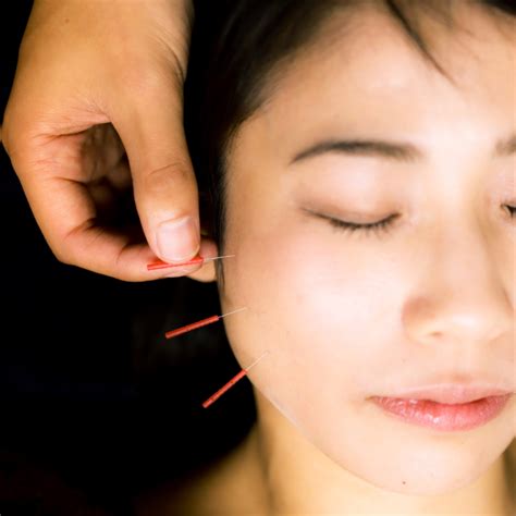 facial acupuncture  village acupuncture  health clinic