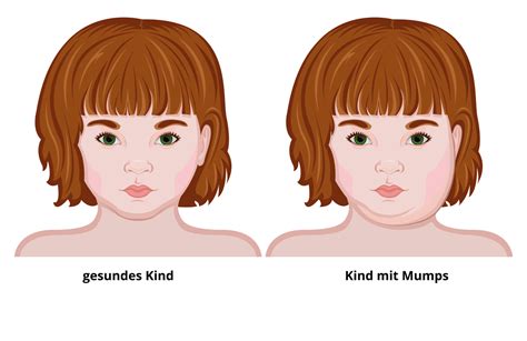 Mumps Symptome - typische Anzeichen erkennen - was tun?