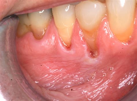 Tobacco And Gum Disease at Richard Peay blog