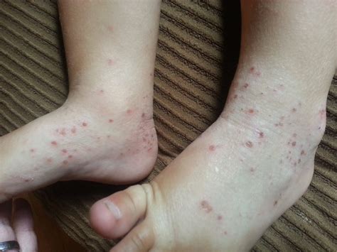Rash on Legs Causes, Symptoms, Itchy, Remedies and Treatment - American ...