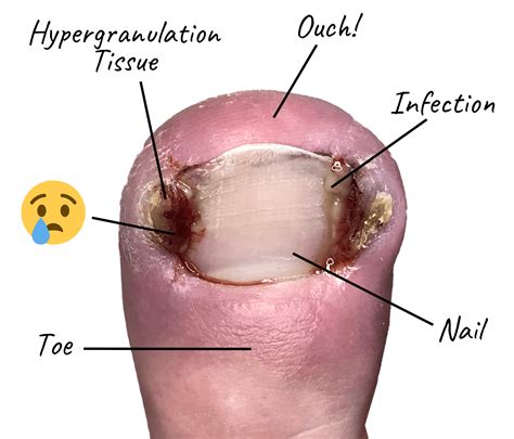 Purple Under Toenail Big Toe Toenail Falling Off: What To Do, Causes,