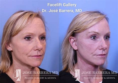Our patient presented with dermatochalasis of the upper and lower ...