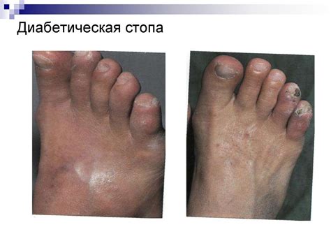 Сестринский уход при сахарном диабете - презентация онлайн