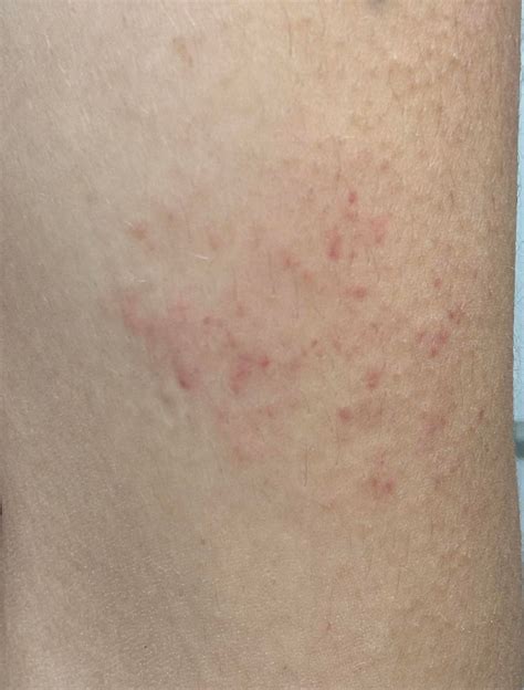 Dupixent Leaked Out Of Injection Site