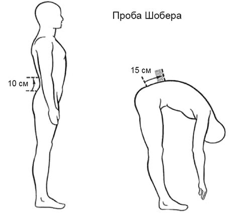 Двухсторонний сакроилеит: что это такое, причины, степени, лечение