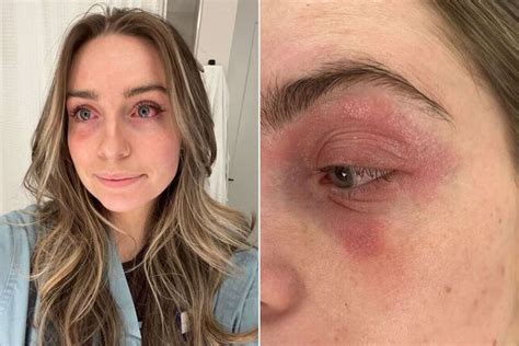 Woman Finds Cause of Severe Skin Reaction That Lasted Months (Exclusive)