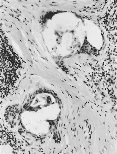 Pathology Outlines - Microcalcifications