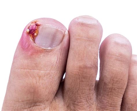 Causes And Symptoms Of An Ingrown Toenail - Ask The Nurse Expert