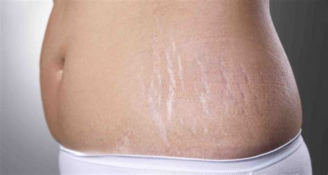 Primeiros Sinais De Estrias - Estrias Fibroatelectásicas Nos Lobos Inferiores - RETOEDU