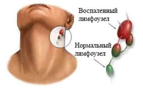 Воспаление лимфоузлов на шее: симптомы и лечение