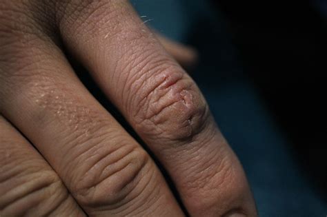 Scar Finger Stock Photo - Download Image Now - Adult, Adults Only ...