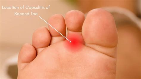 toe pain  walking