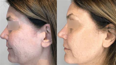 Cryoskin Treatment: Full Review & Reasons To Do (Or Not) | Heliotherapy ...