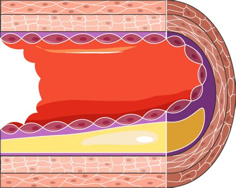 Atheroma - Servier Medical Art
