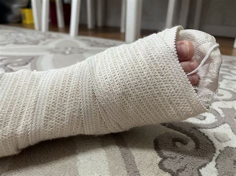 Перелом ноги в три года, как мы с этим справились