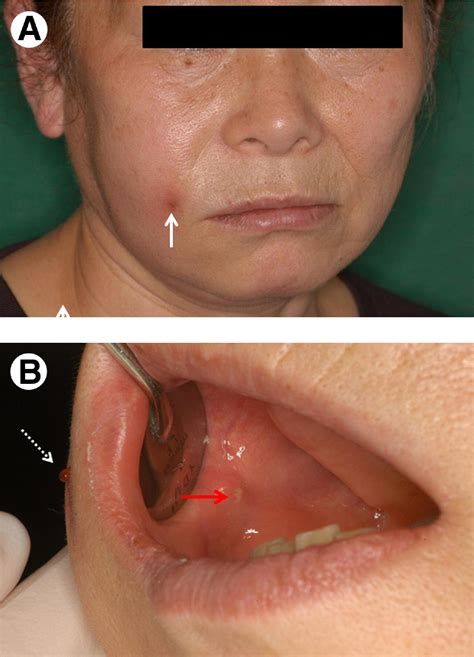 Swollen Parotid Gland