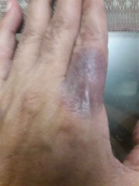Ask a Dermatologist Online for Purple Patches On Both Hands