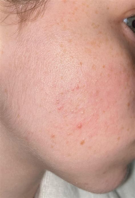 Struggling with skin texture after accutane [acne] : r/SkincareAddiction