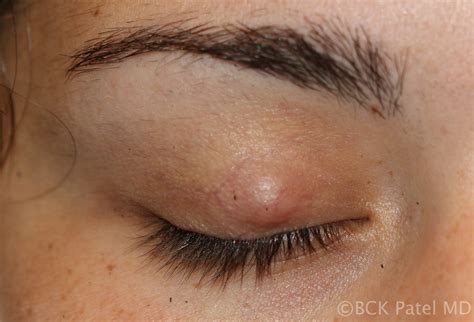 Moran CORE | What are the differences between a stye, a chalazion, an ...