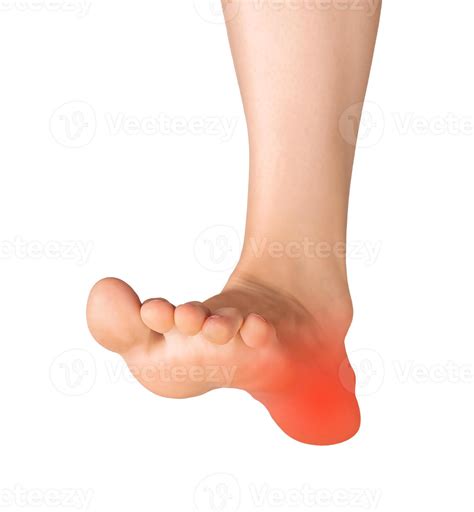 foot with a painful heel, isolated on a white background. Medical