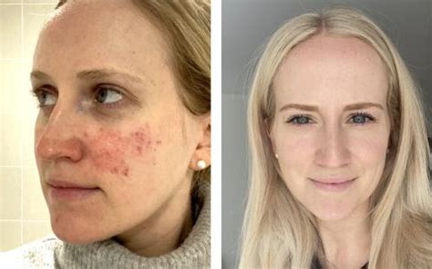 National Rosacea Society | Rosacea.org