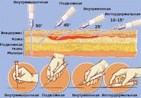 Траумель уколы: инструкция по применению, цена