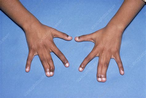 Webbed Hands