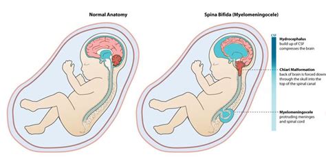 23 best Spina bifida images on Pinterest | View source, Babys and Search
