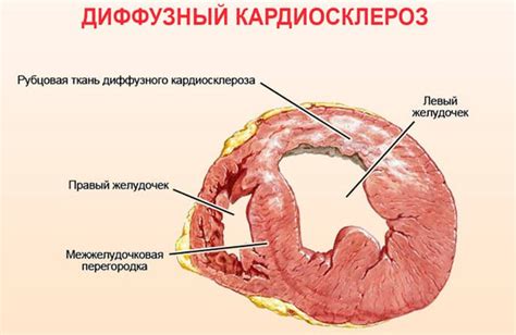 Диффузный кардиосклероз: как обнаружить и лечить - DavlenieNorm