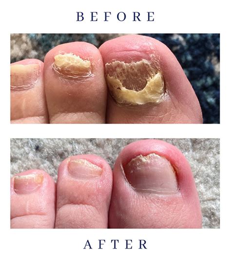 Class 4 Laser Treatment for Toenail Fungus - District Foot & Ankle