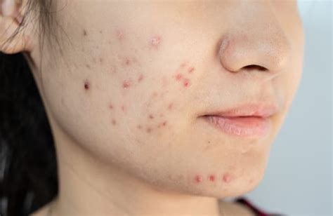 early warning signs  head  neck cancer