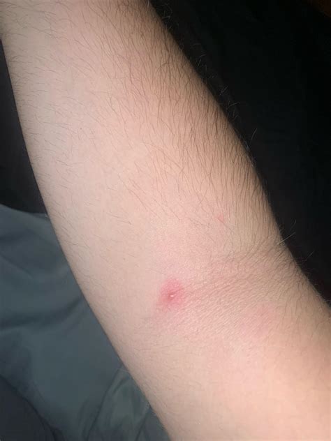 what is this bump on my elbow crease? painful upon touch, will not pop ...