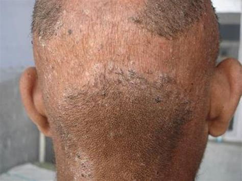 keratosis follicularis - pictures, photos