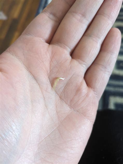 My pinky toenails grow flat, and the side facing my other toes