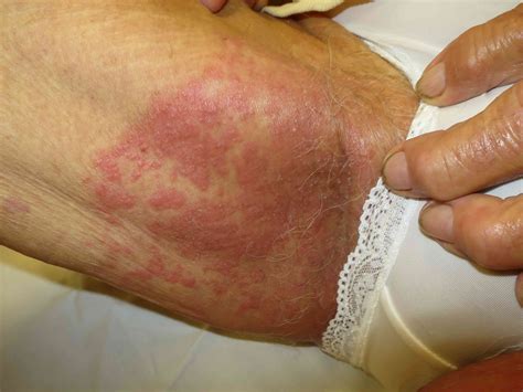 12 Tips to Help Women Manage Inner Thigh Rash
