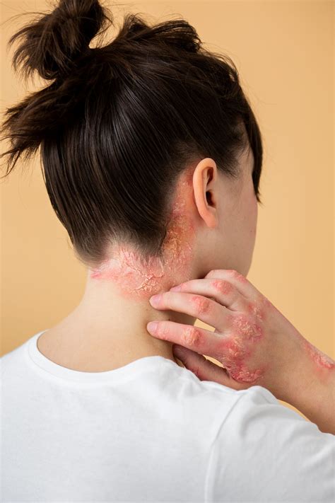 A Guide to Psoriasis and Eczema: Know Your Rash | by ...