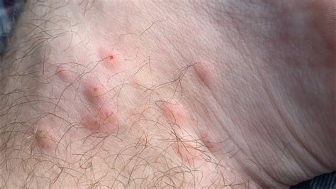 Scratching mosquito bites on foot after long trip home - YouTube