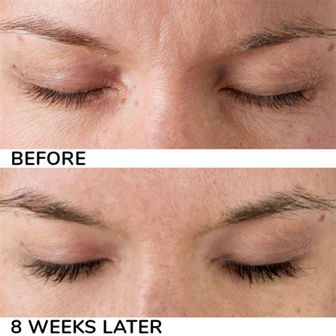 Latisse Before And After 4 Weeks