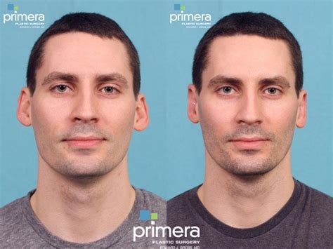 otoplasty earlobe repair  orlando winter park tampa fl