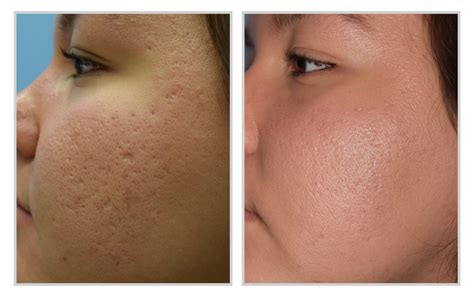 skin treatments halo laser treatment downtime aftercare during the