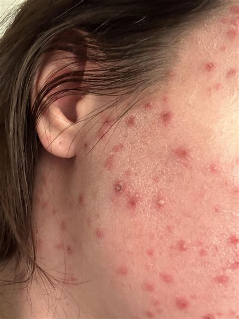 Mild Chickenpox In Adults
