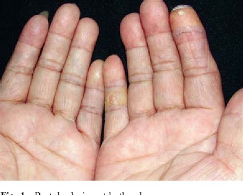 Tophus Most Common Location