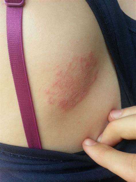 Hautausschlag am Rücken! (Krankheit, Haut, Ausschlag)