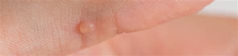 Wart (Verruga) (HPV). - Ciocca Dermatology